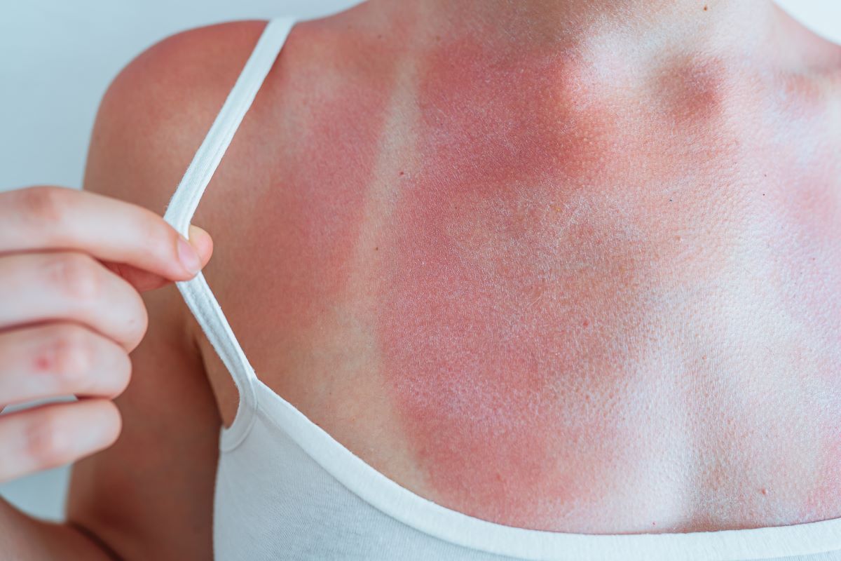 Sonnenbrand in Karlsruhe vermeiden, behandeln und ernst nehm